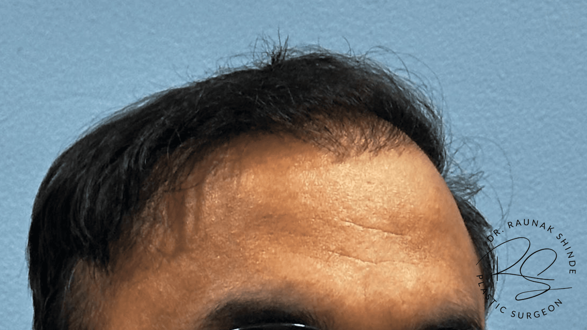 Before and After Results 1