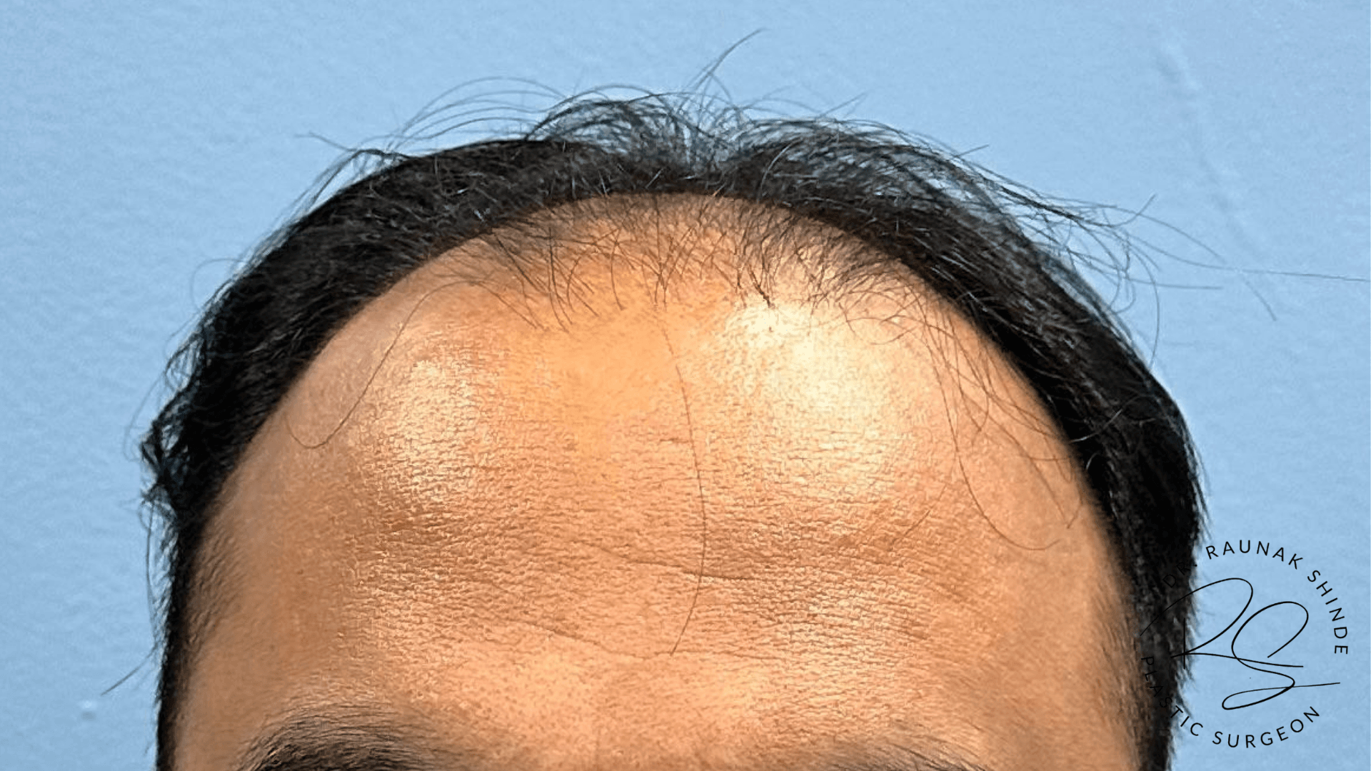 Before and After Results 2