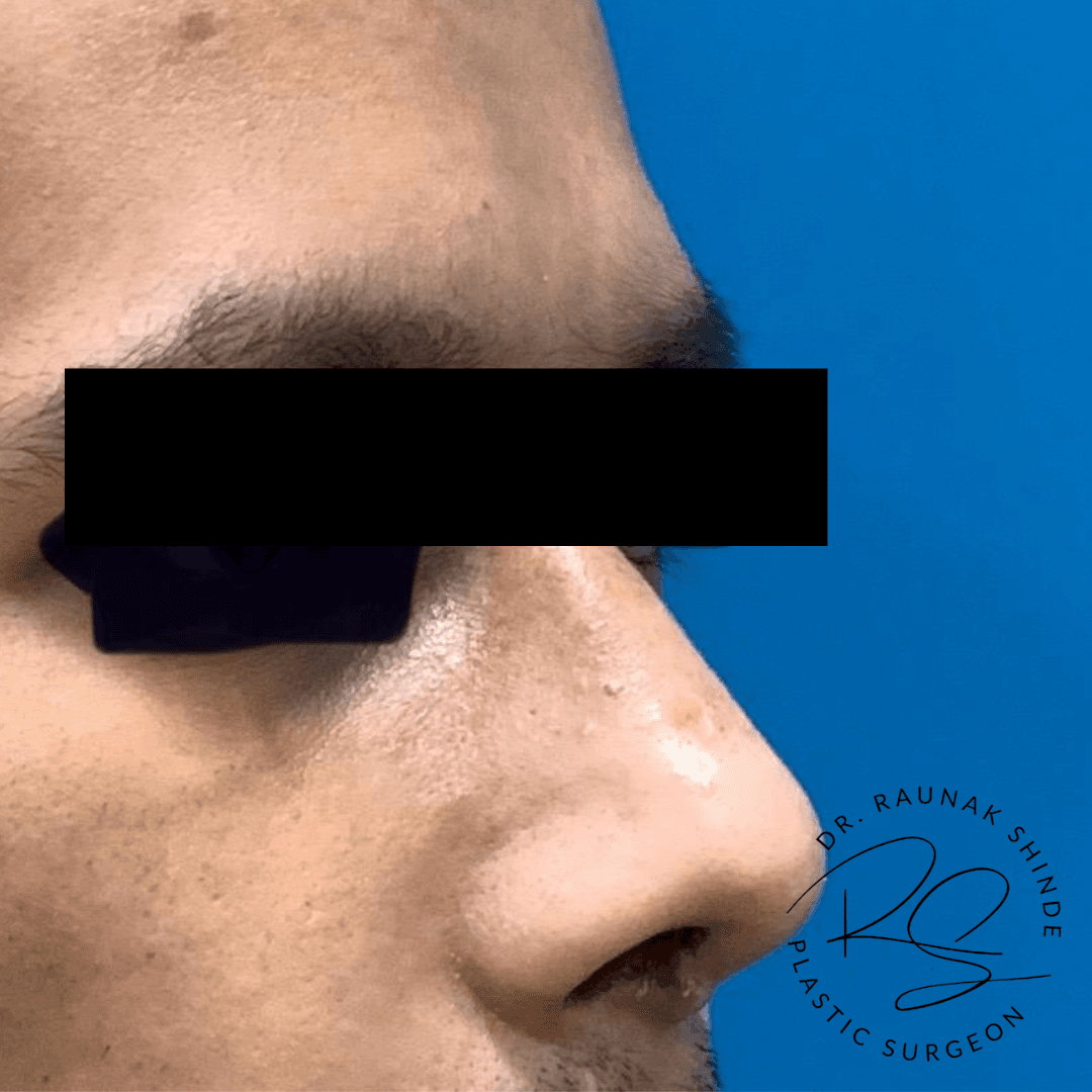 Before and After Results 1