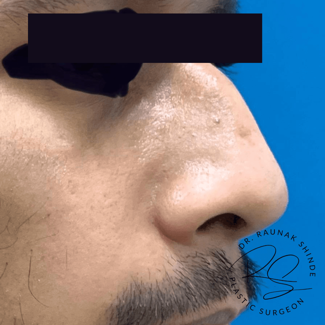 Before and After Results 2